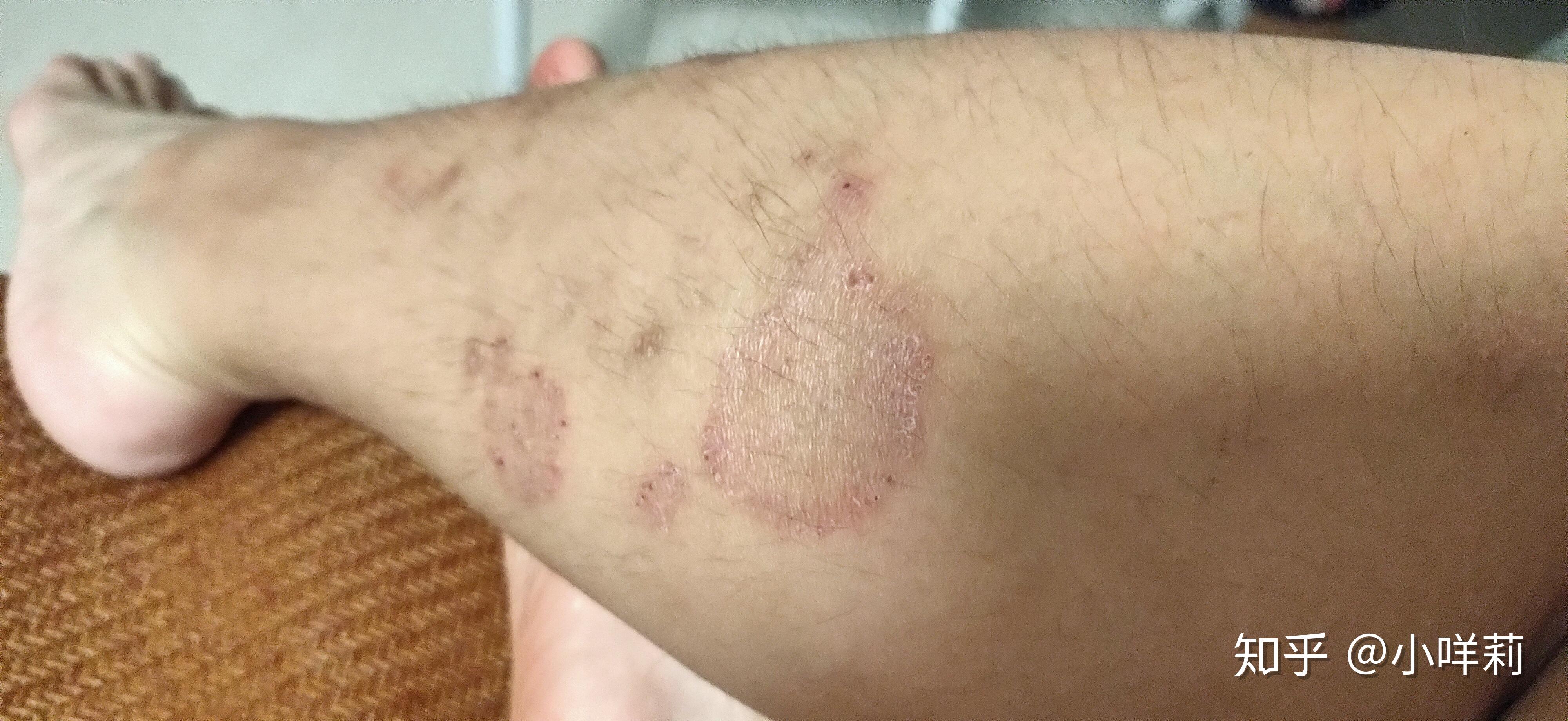 人得了猫癣怎么治疗啊?急 - 知乎