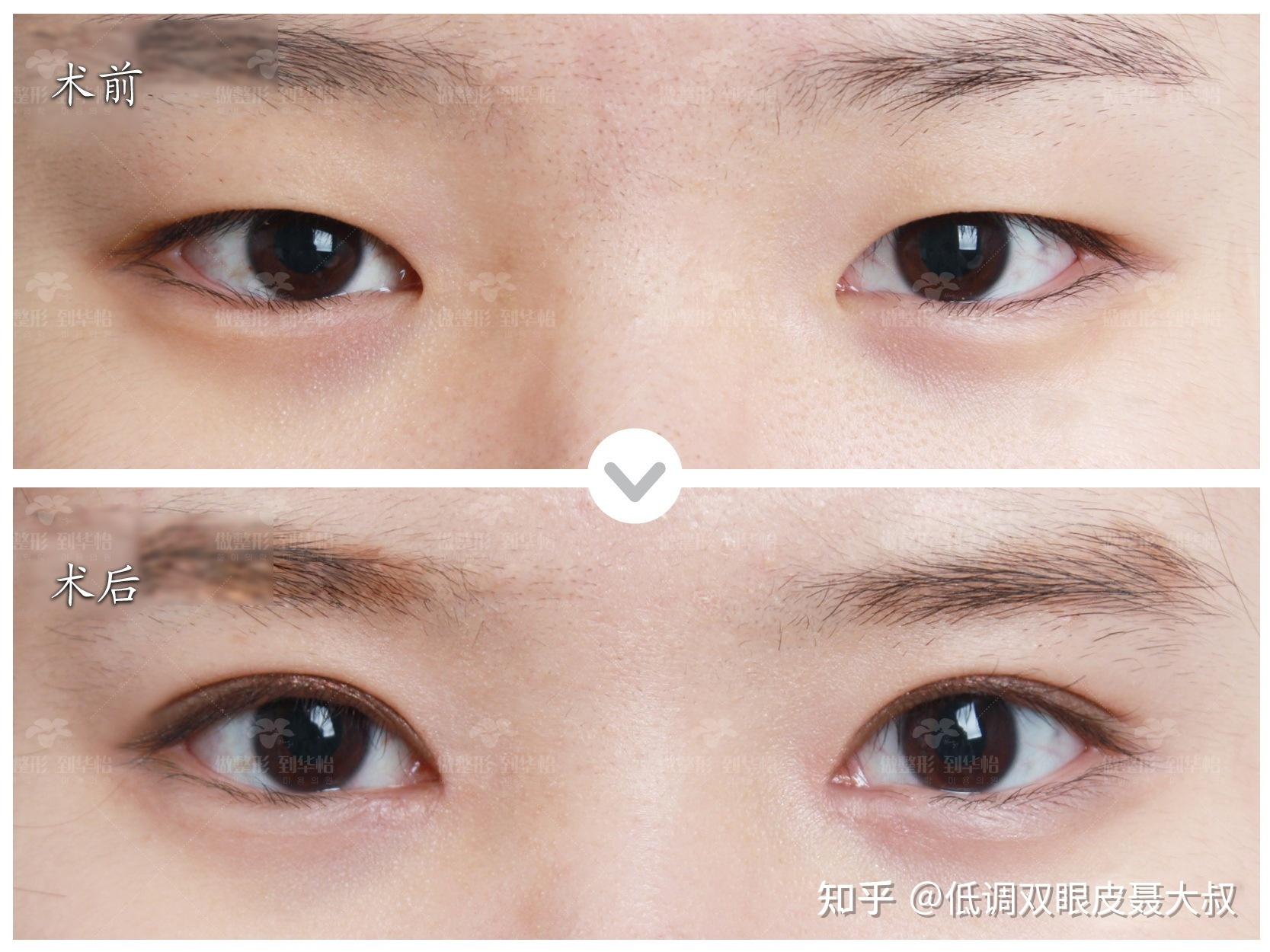 七毫米的双眼皮宽不宽呀