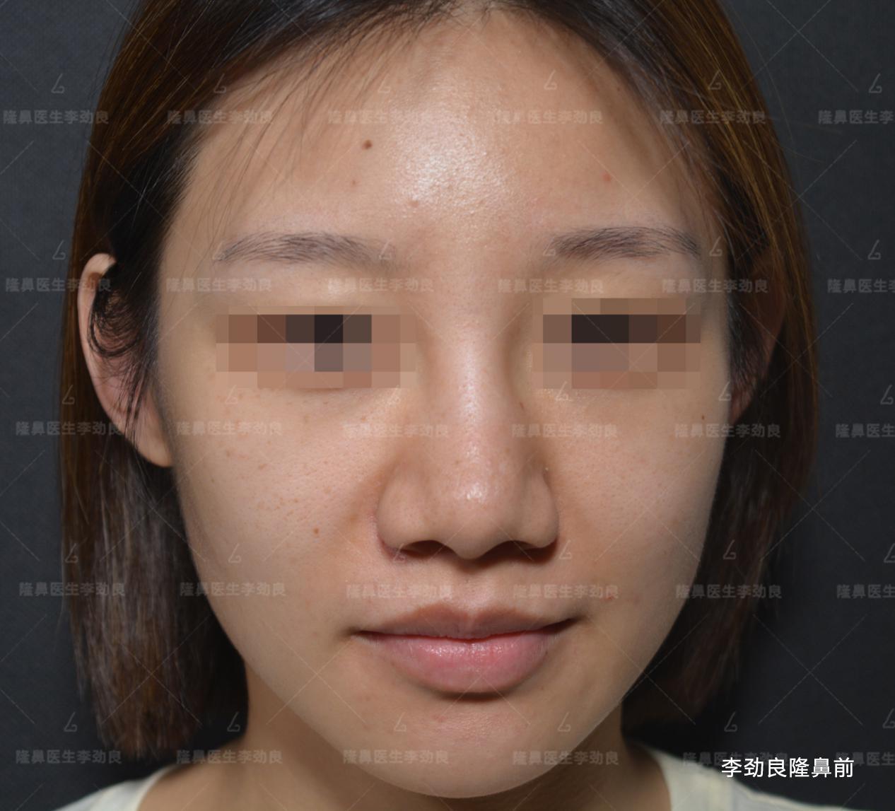 有人通过埋线缩鼻翼的吗? - 知乎