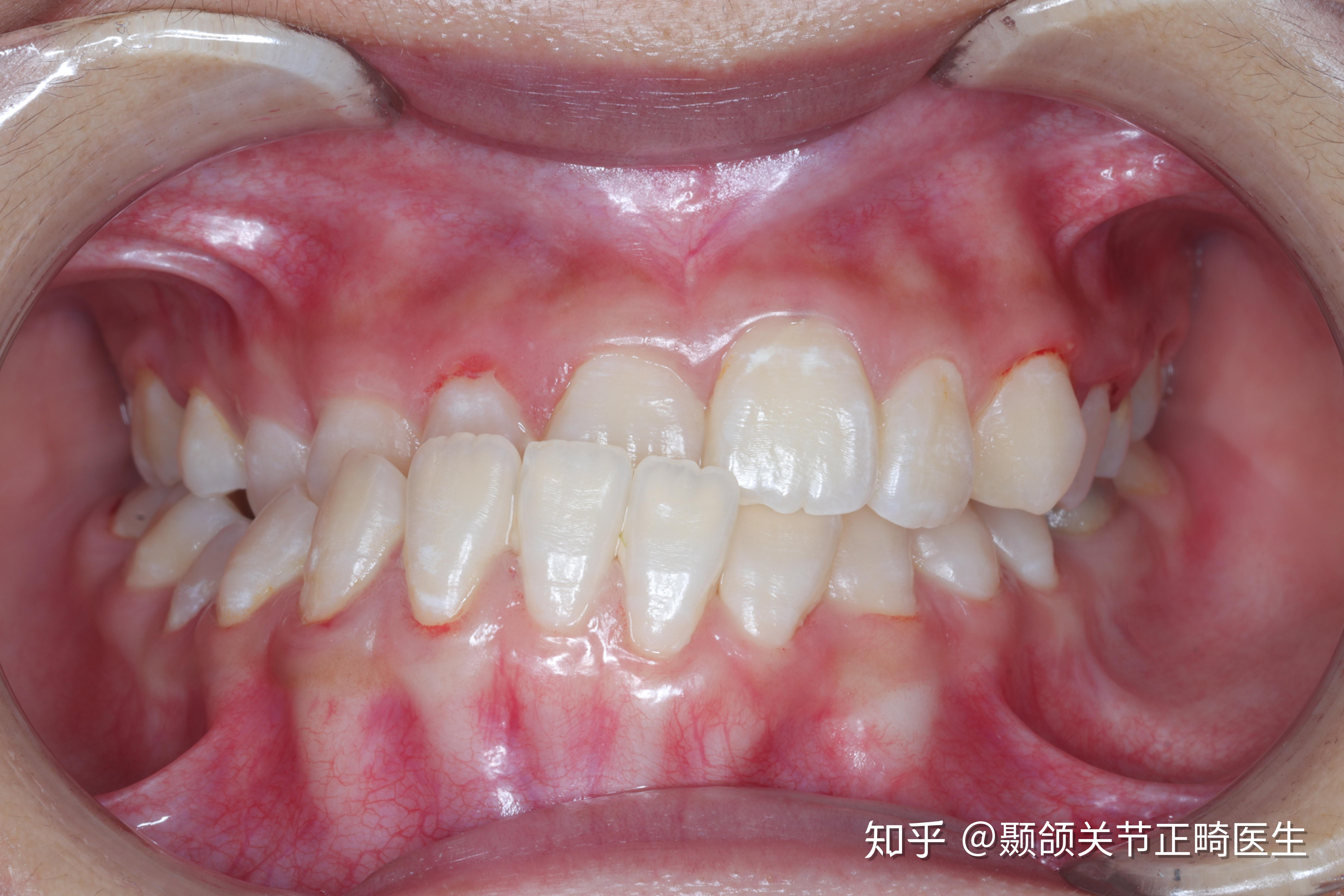 左边地包天右边天包地略微影响脸型整牙的话难度和风险大吗