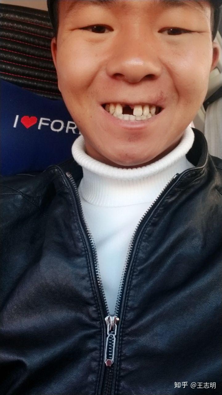 门牙掉了是一种怎样的体验