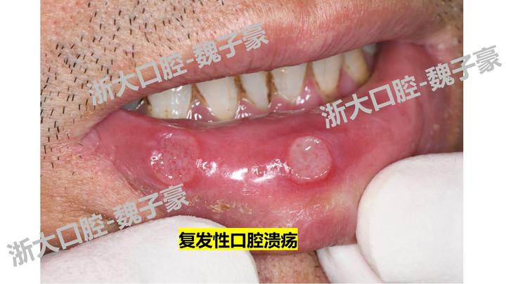 复发性阿弗他溃疡（RAU）简介 - 知乎