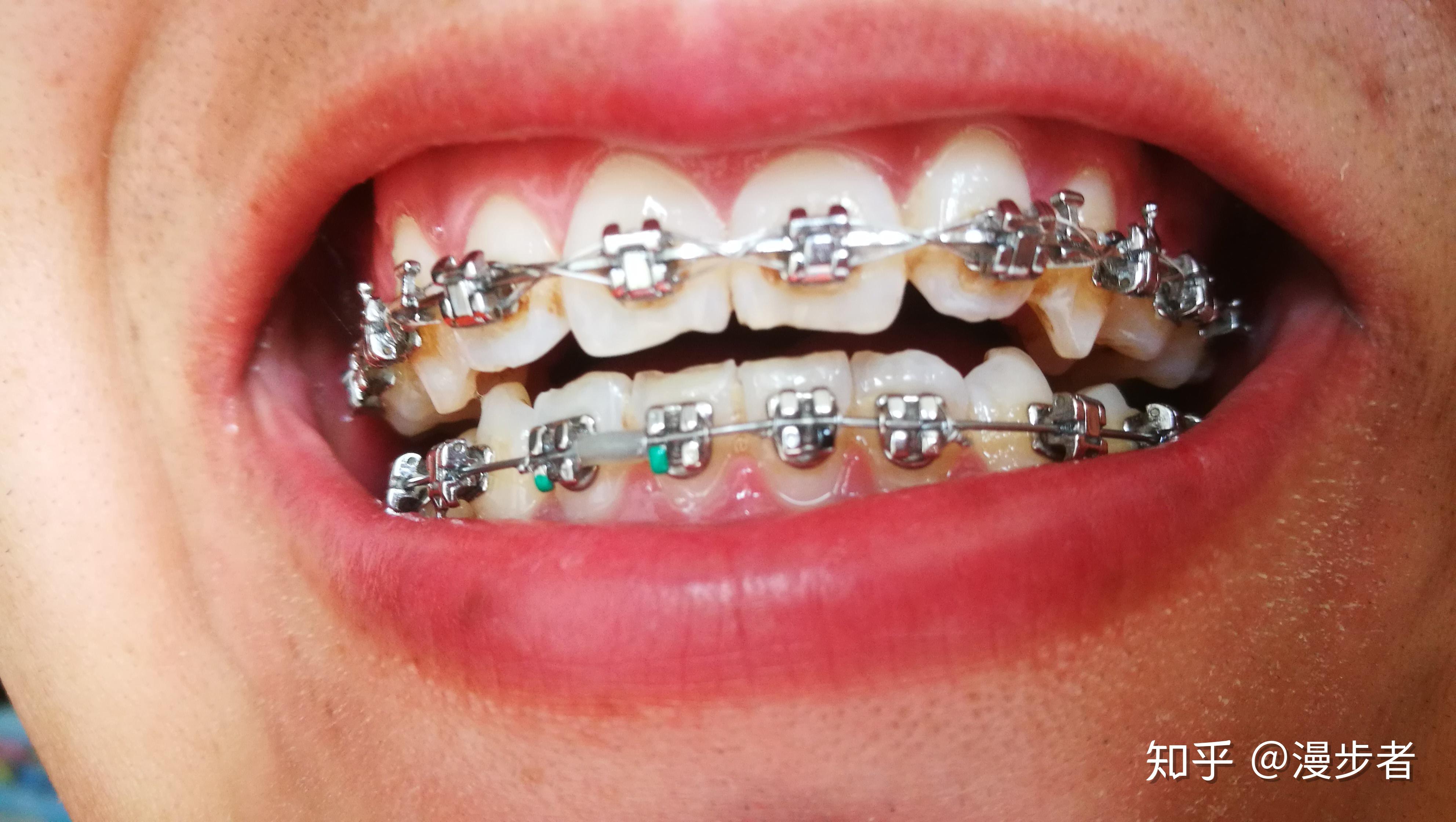 正畸用的进口的自锁托槽和国产的自锁托槽有什么区别? - 知乎