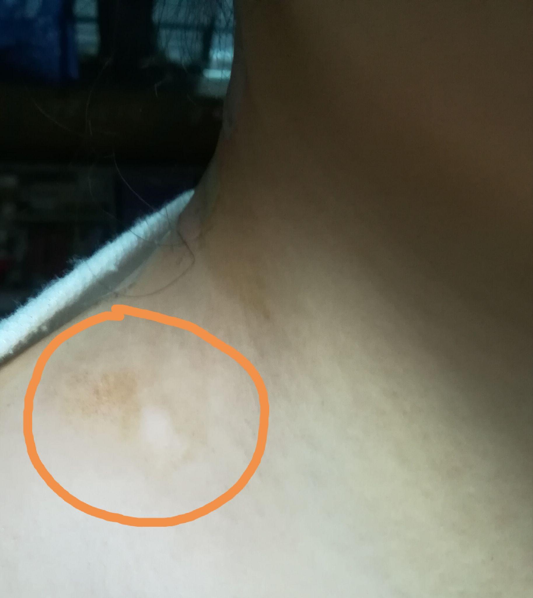 脸上有一角钱大小的晕痣有没有希望复原