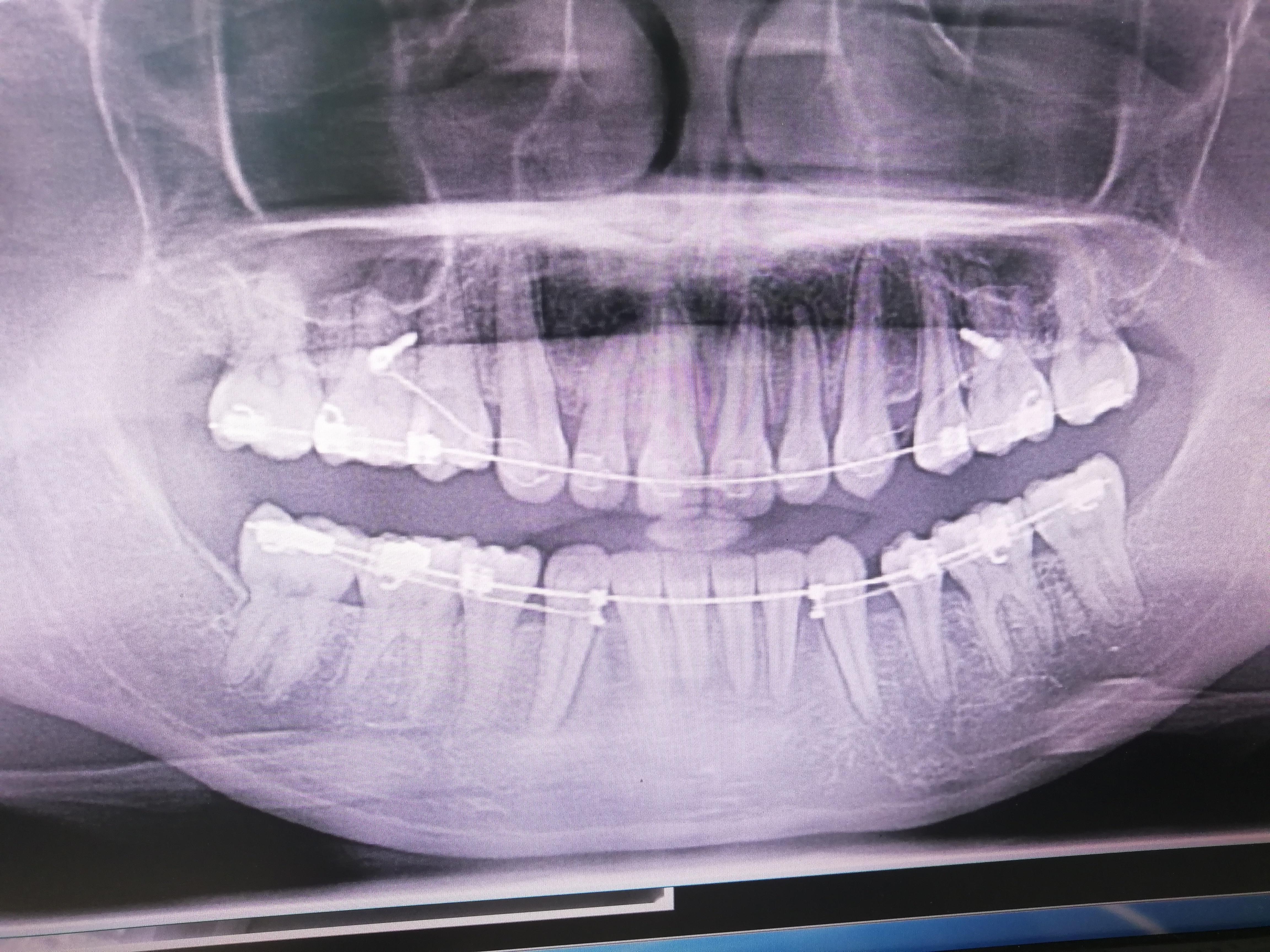 下颌神经管离智齿牙根很近医生说拔牙中可能损伤神经引起嘴唇麻木