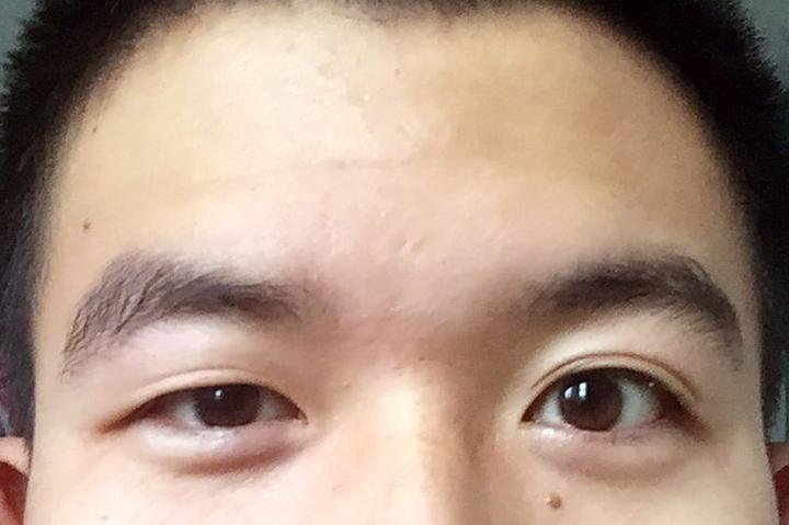 眼睛一大一小怎么办