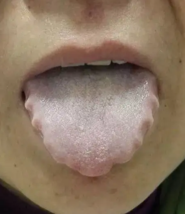 舌质淡苔薄白图片图片