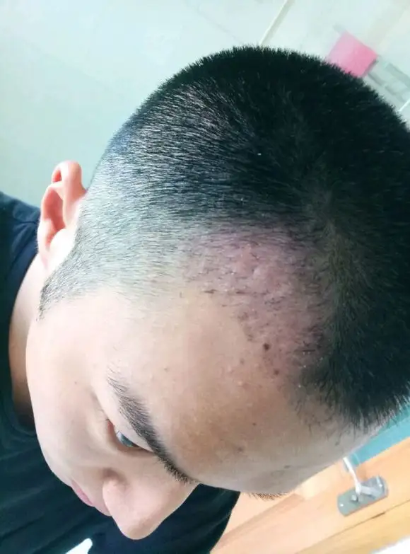 植发后5个月毛囊炎,有没有和我一样的,你们毛囊炎怎么处理好的? - 知乎