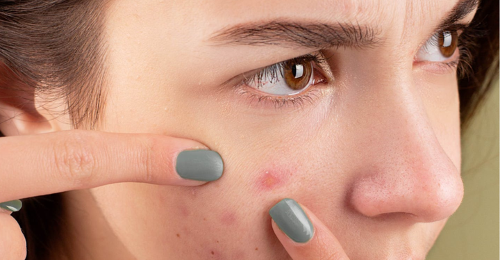 夏天暴晒除了会长斑,还会长痘你知道吗?