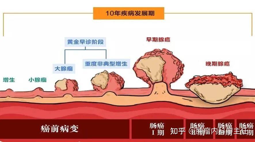 肠息肉到什么程度需要手术演变成肿瘤的可能有多大