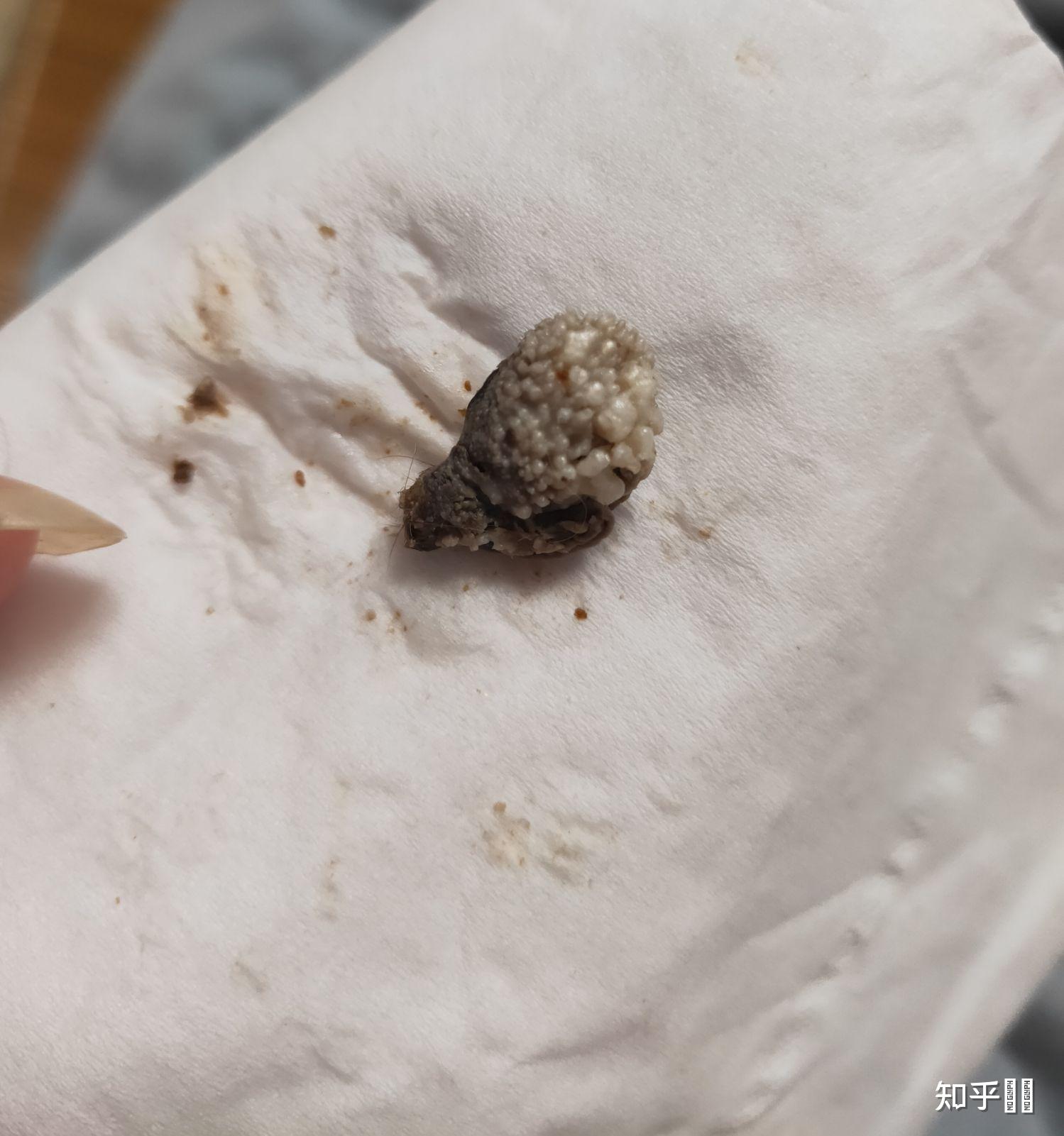 肚脐眼里面的灰可以抠吗抠了肚子会进风人会生病之类的说法正确吗是否