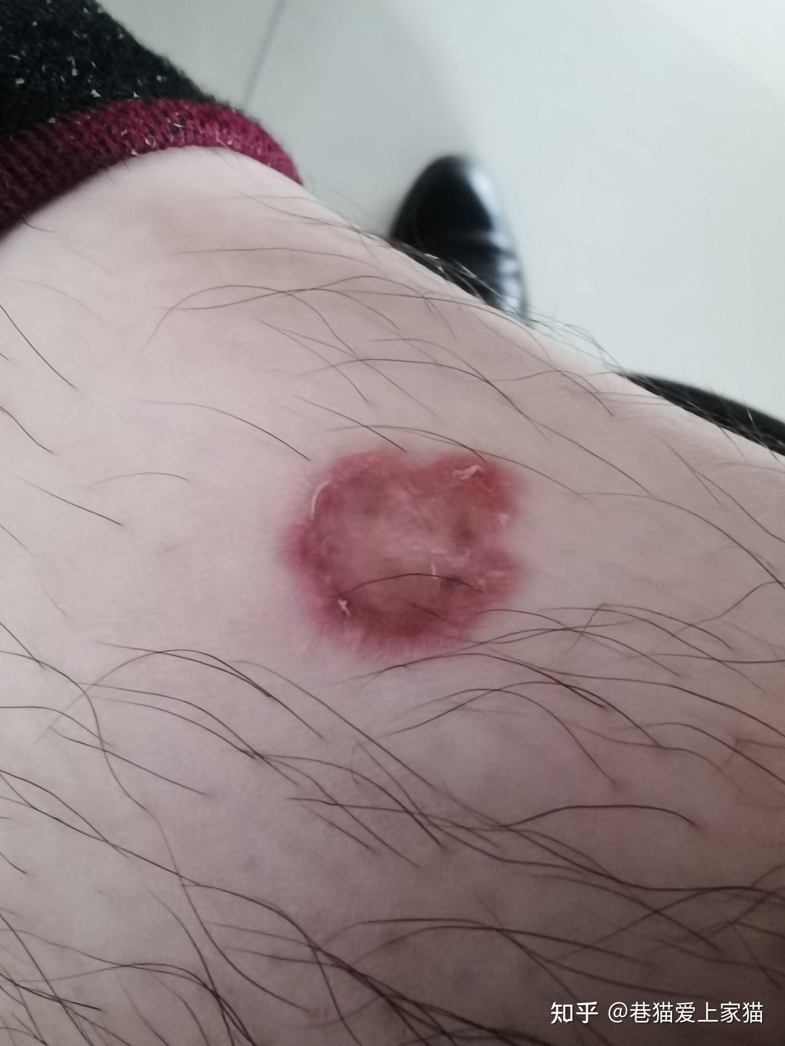 猫传染给我猫癣十几天不好怎么办