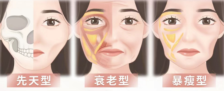 不同程度的面颊凹陷如何改善？ - 知乎