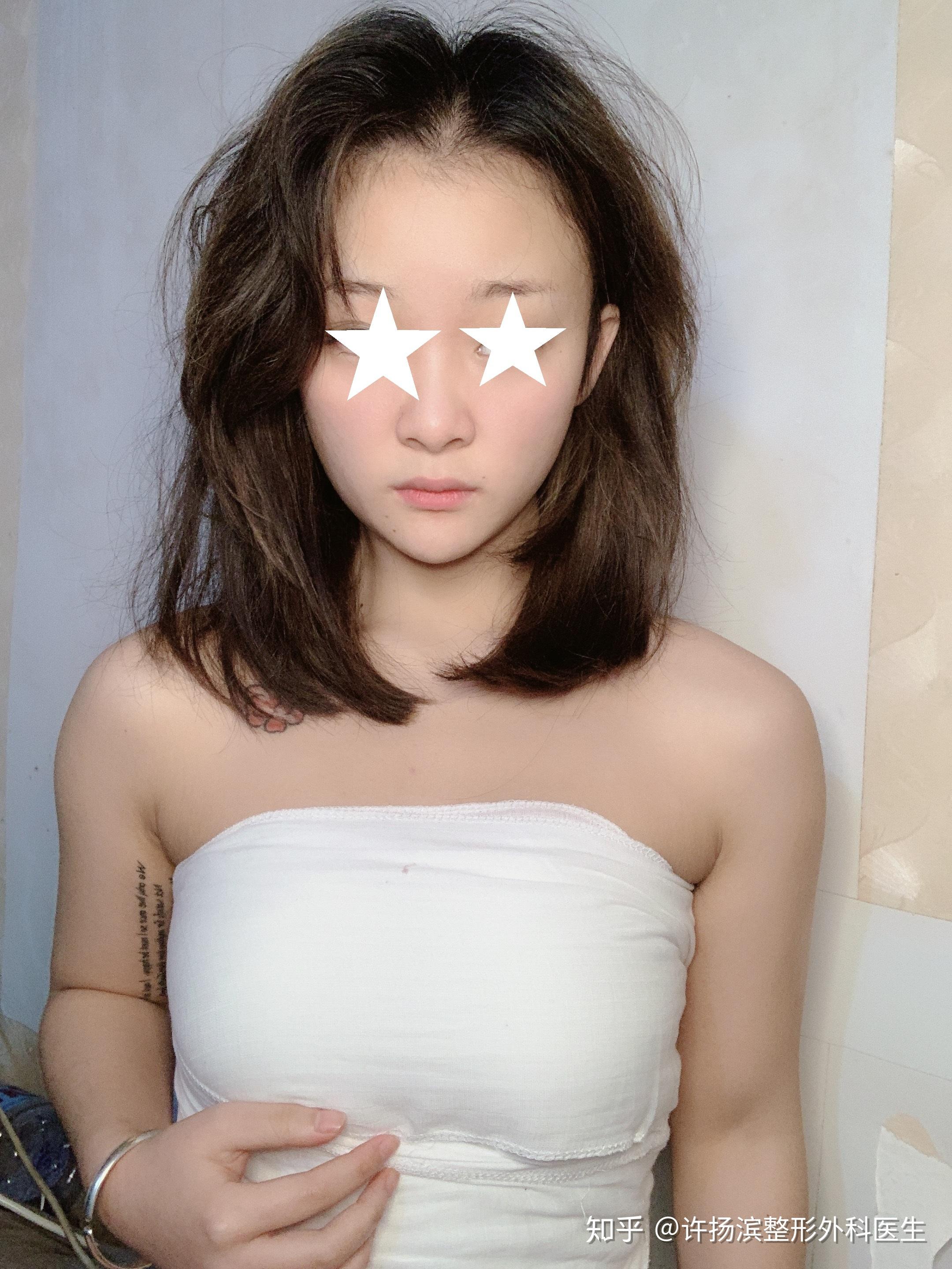 假体隆胸半年后的真实感受?后悔吗? - 知乎