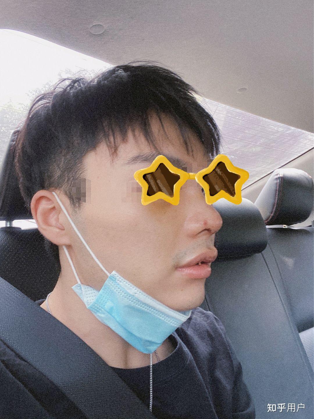 男生做鼻综合是什么体验? - 知乎