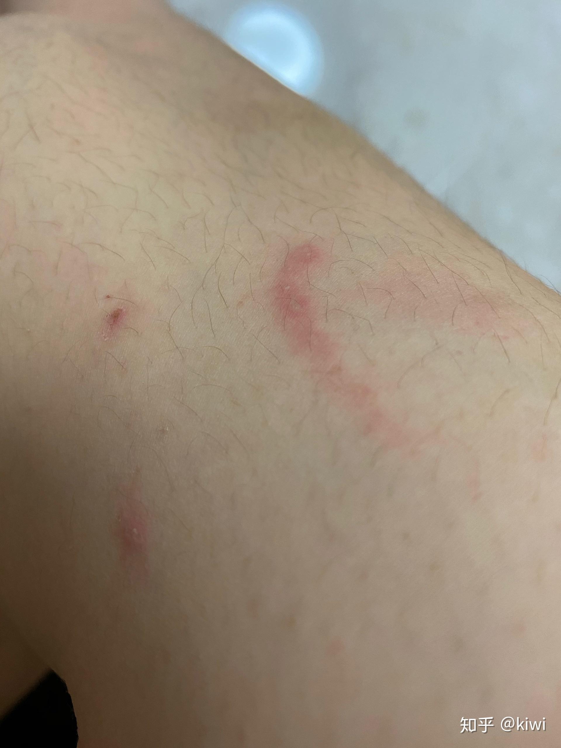 被隐翅虫咬了会怎么样