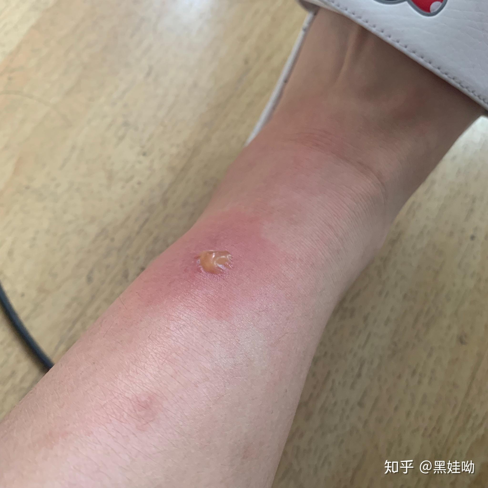 被蚊子咬的包第二天都肿的特别大怎办? - 知乎
