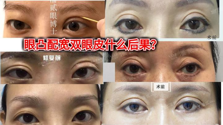 凸眼睛者：眼球突出高于眉骨、上睑凹陷和（或）多层，双眼皮设计为何不宜过宽？ - 知乎
