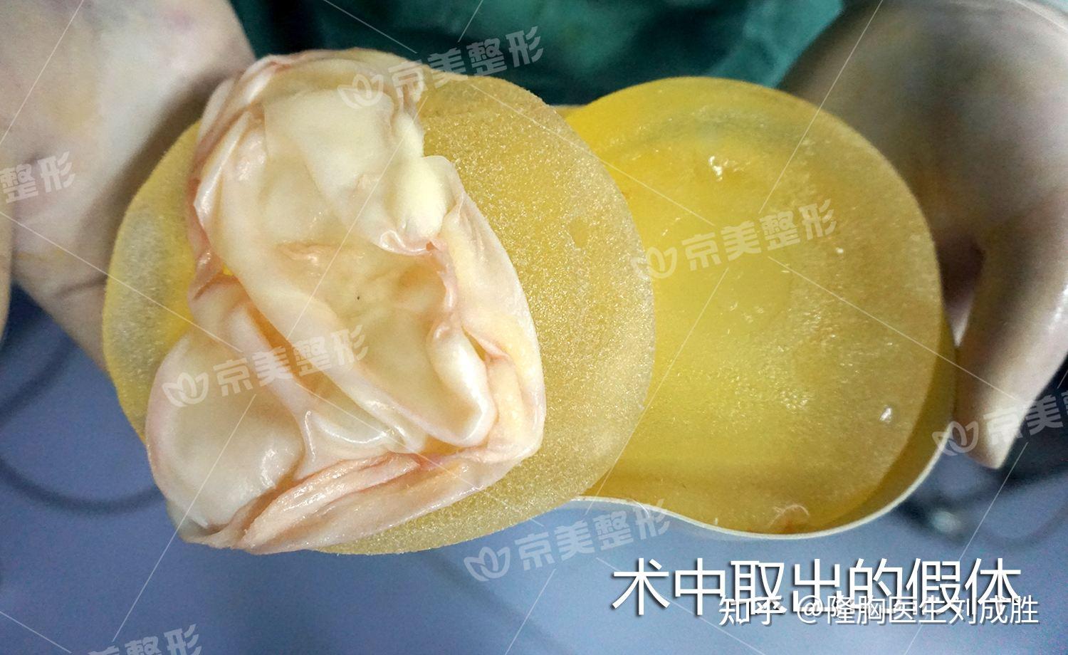 假体隆胸的包膜挛缩究竟指的是什么?