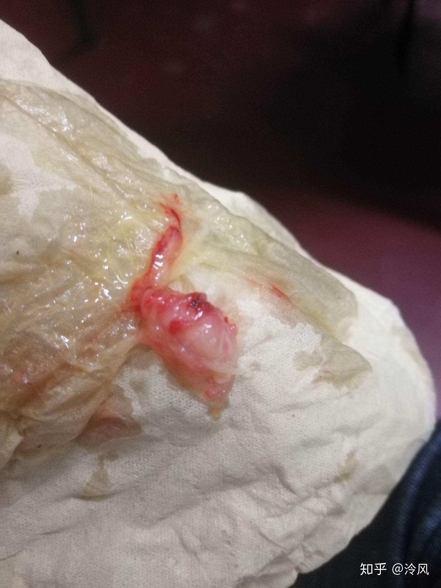 鼻窦炎手术什么体验