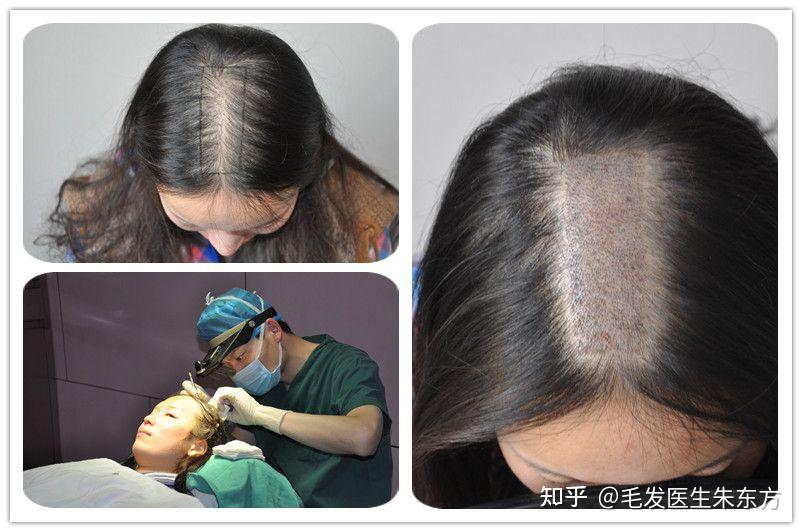 女性头顶稀疏、发缝变宽是什么原因导致的?该怎么办? - 知乎