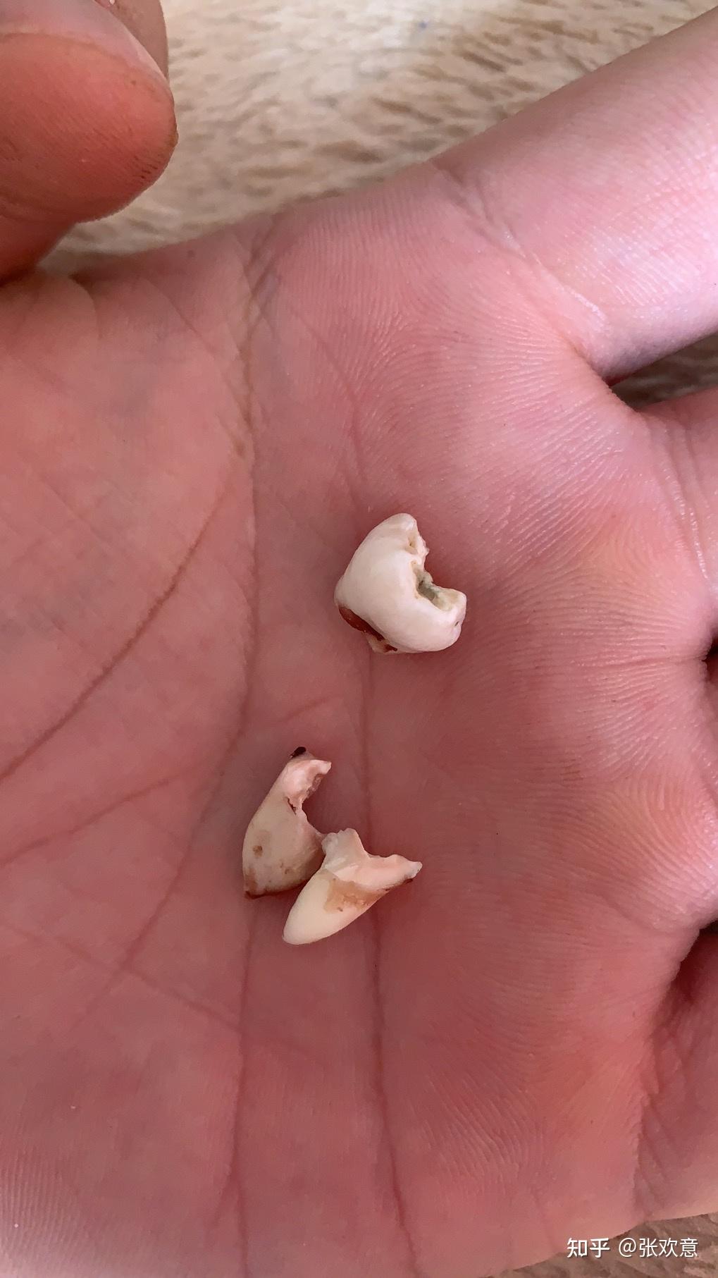 拔横着长的智齿是怎样的体验? - 知乎