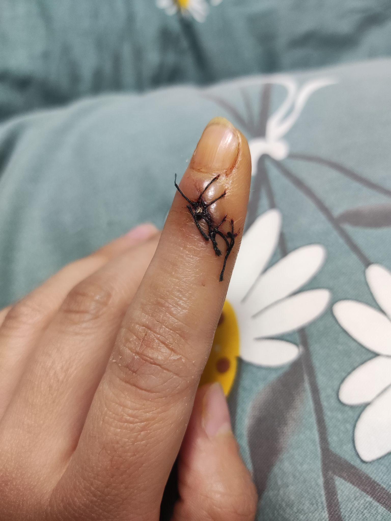 切菜切到手该怎么办? - 知乎