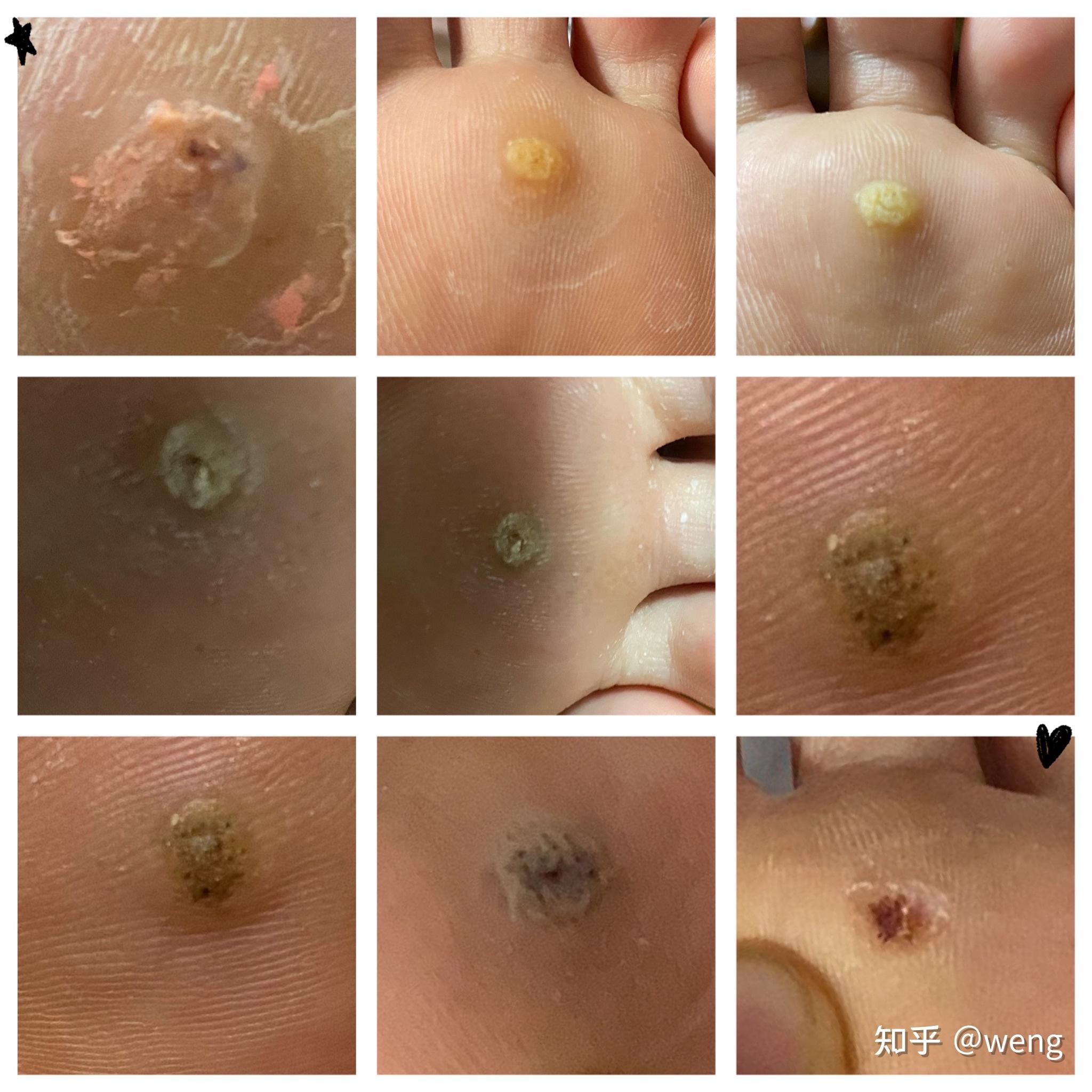 脚底长疣 对身体有伤害吗? - 知乎
