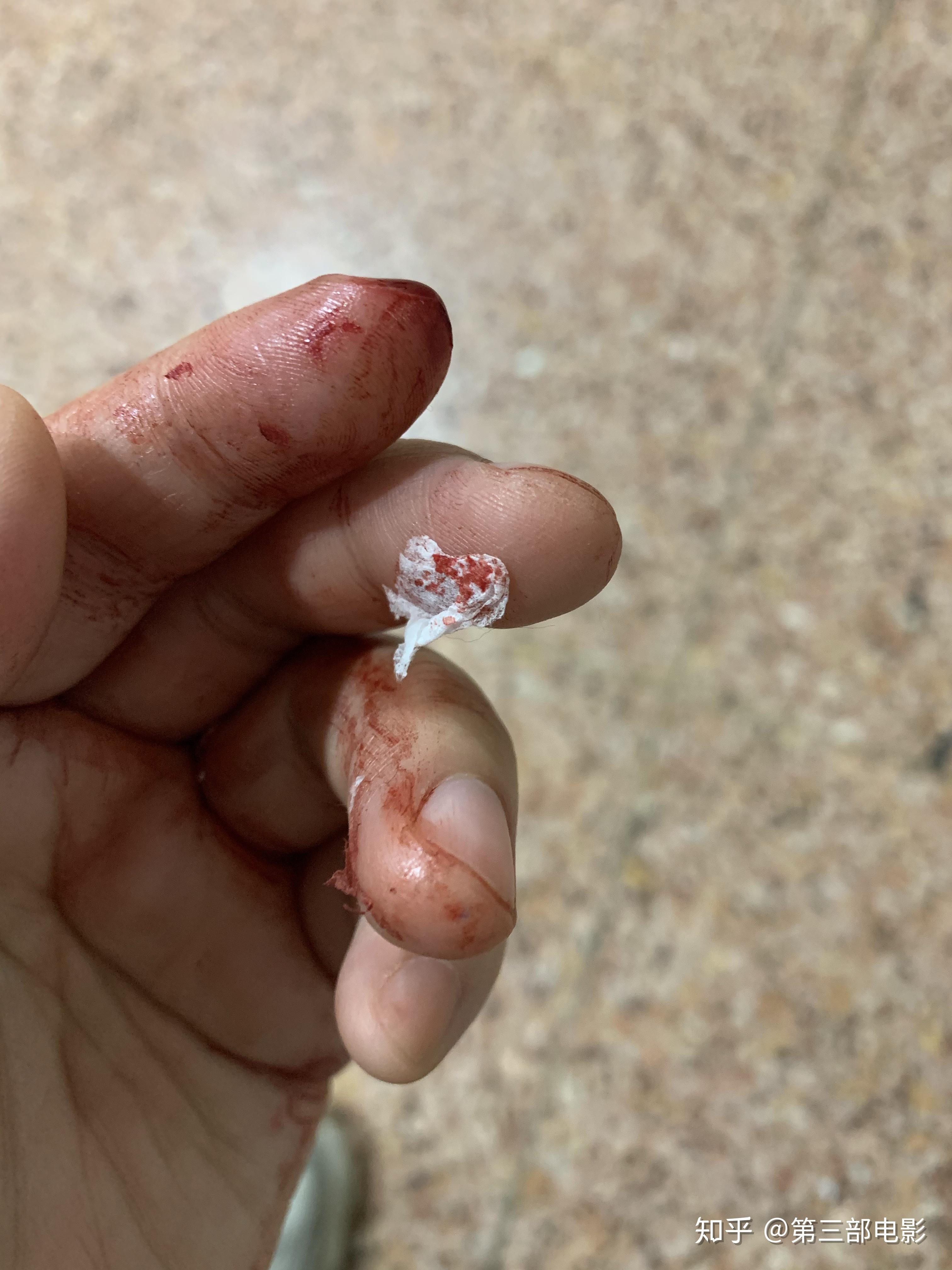 手指被割掉一块肉是什么体验? - 知乎