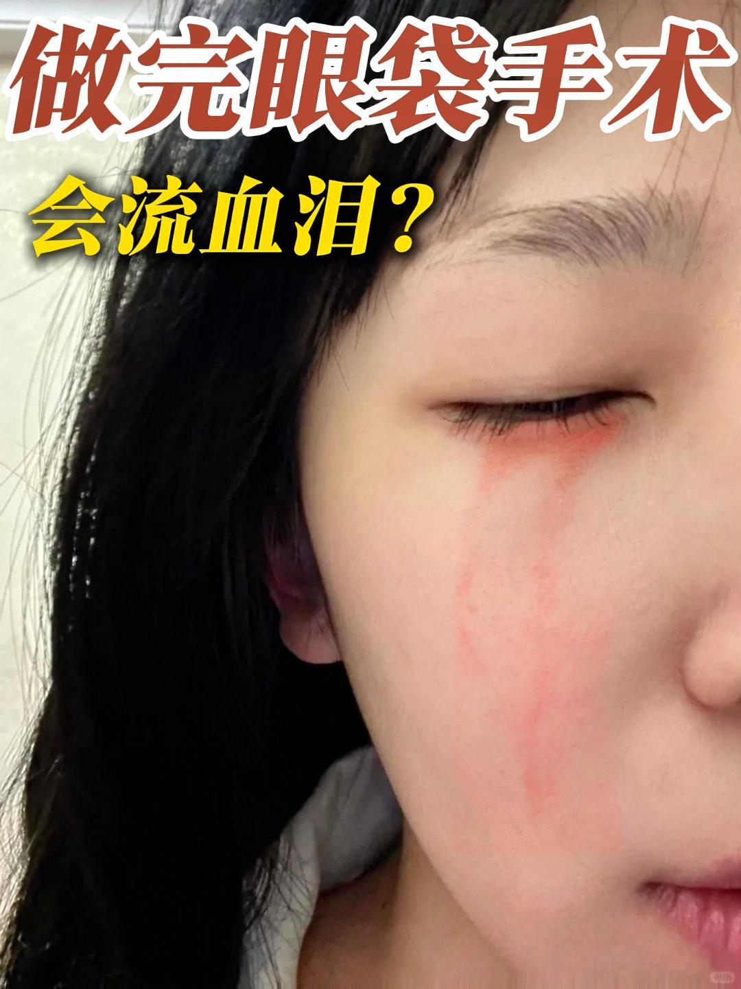 眼袋手术后居然流血泪❗❗❓