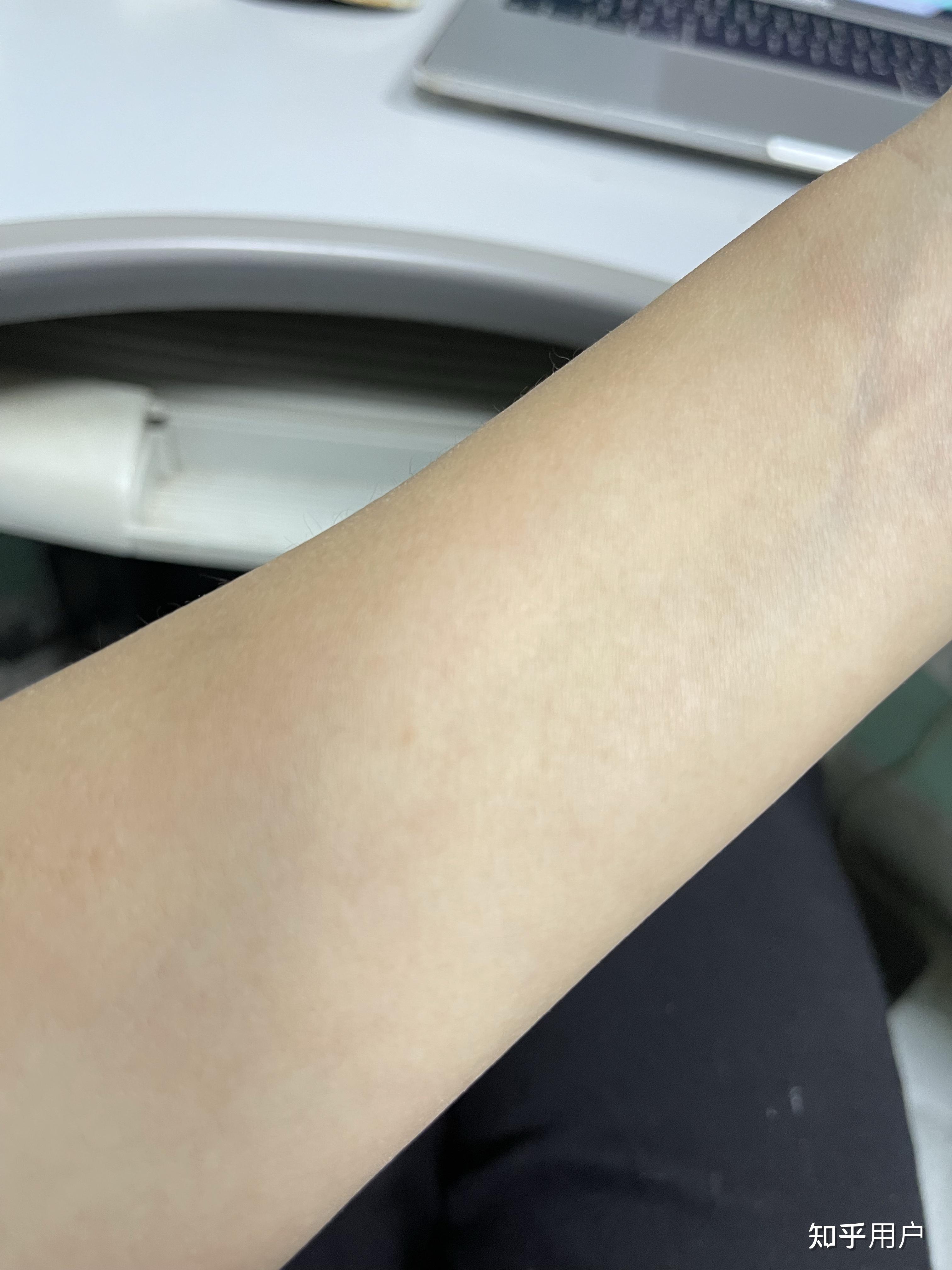 ppd皮试后这个样子怎么办