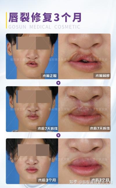【案例分析】15岁少年唇裂术后鼻孔变大、唇弓上提,唇鼻修复手术一并改善! - 知乎
