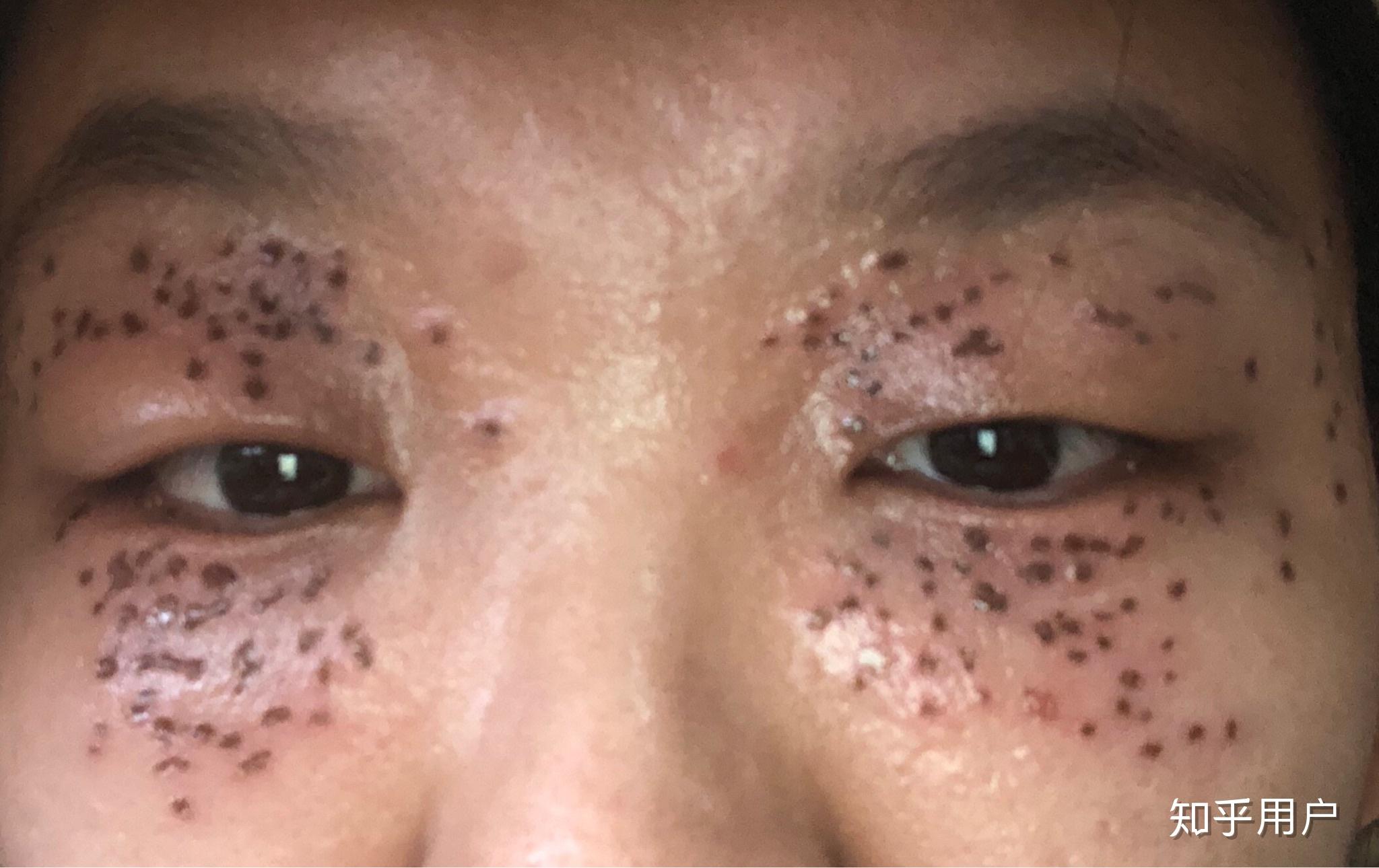 眼睛周围长了很多汗管瘤怎么办