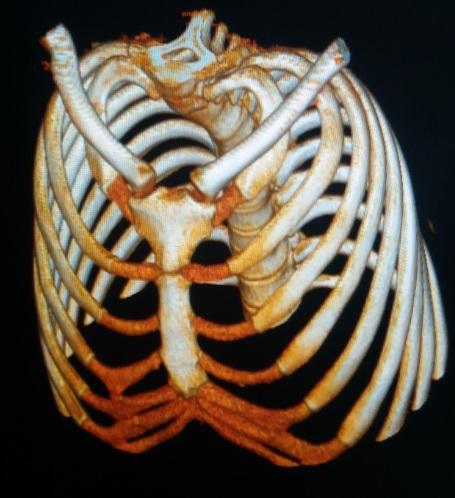 重度桶状胸的"小手术"