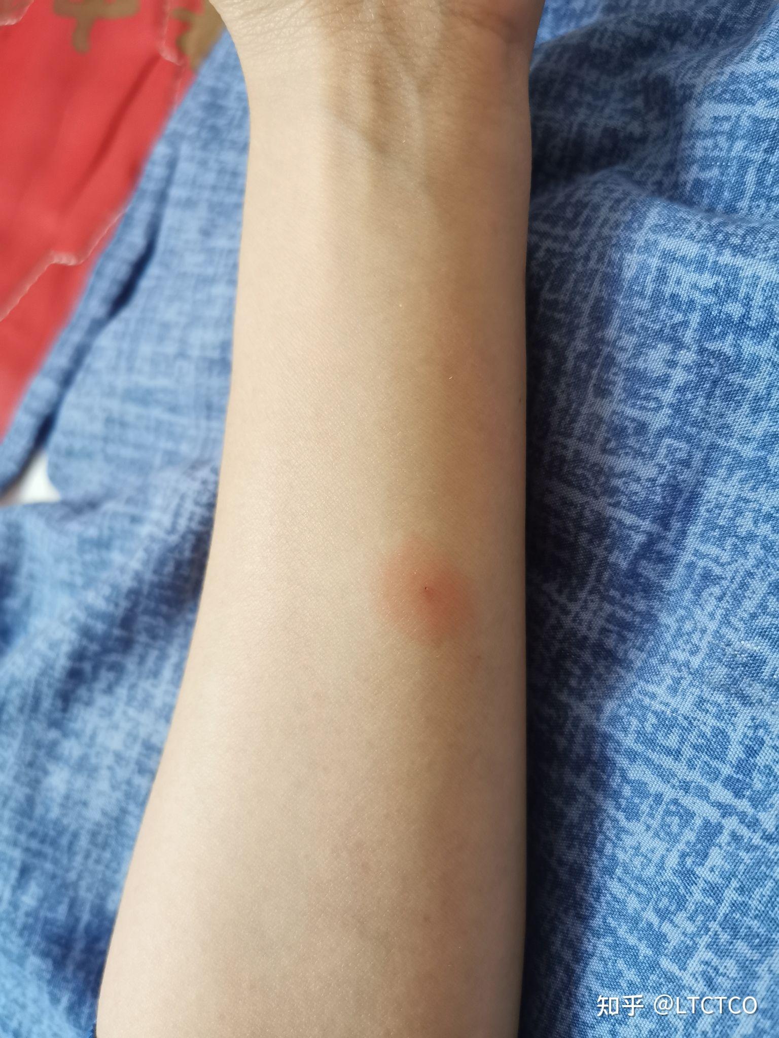 肺结核皮试怎样算是阳性? - 知乎