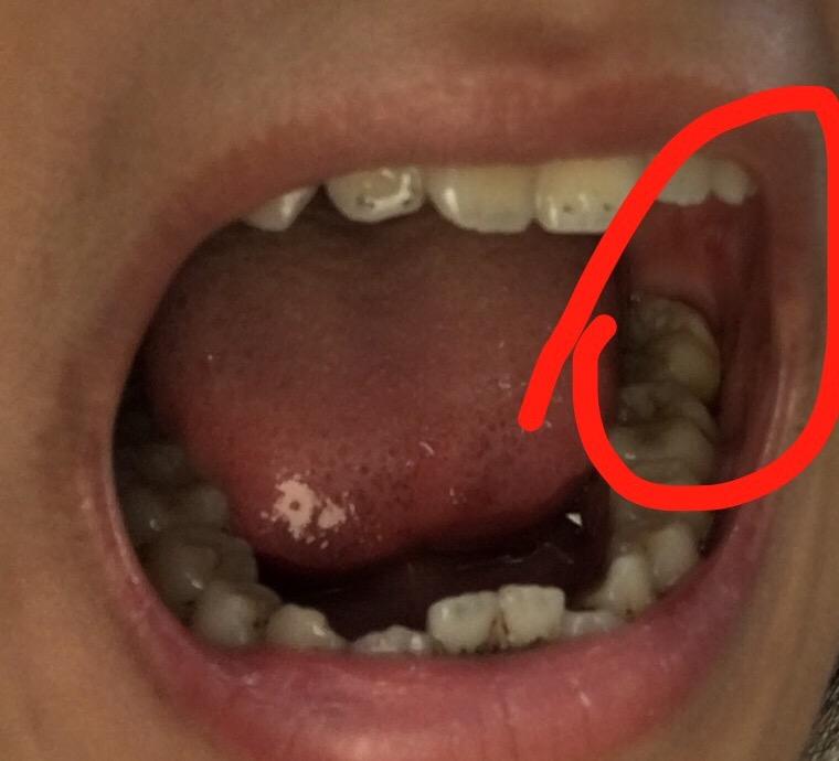 嘴巴里面腮处起了个黑色血泡是怎么回事? - 知乎