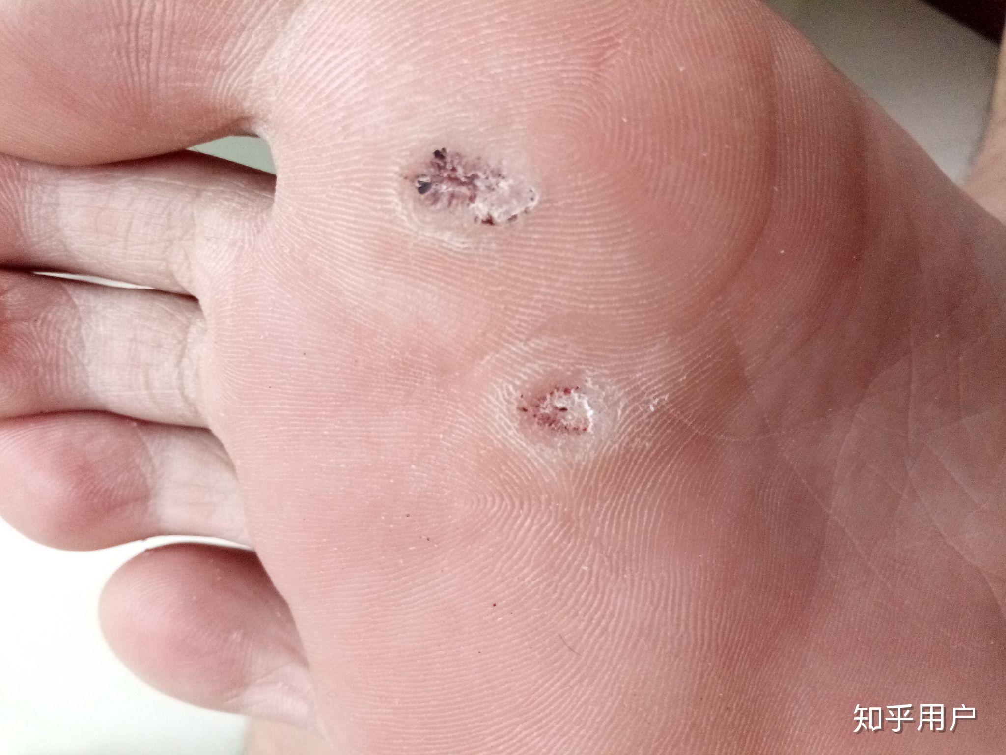 跖疣的自愈性大吗