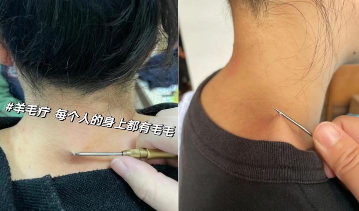 鲜有人知的传统中医外治疗法——羊毛疔挑刺法 - 知乎