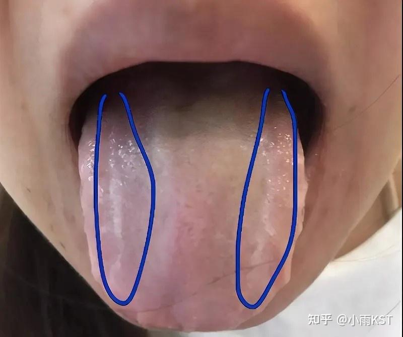 舌头两边有齿痕的原因有哪些? - 知乎