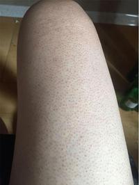 毛囊炎 鸡皮 - 收藏夹 - 知乎