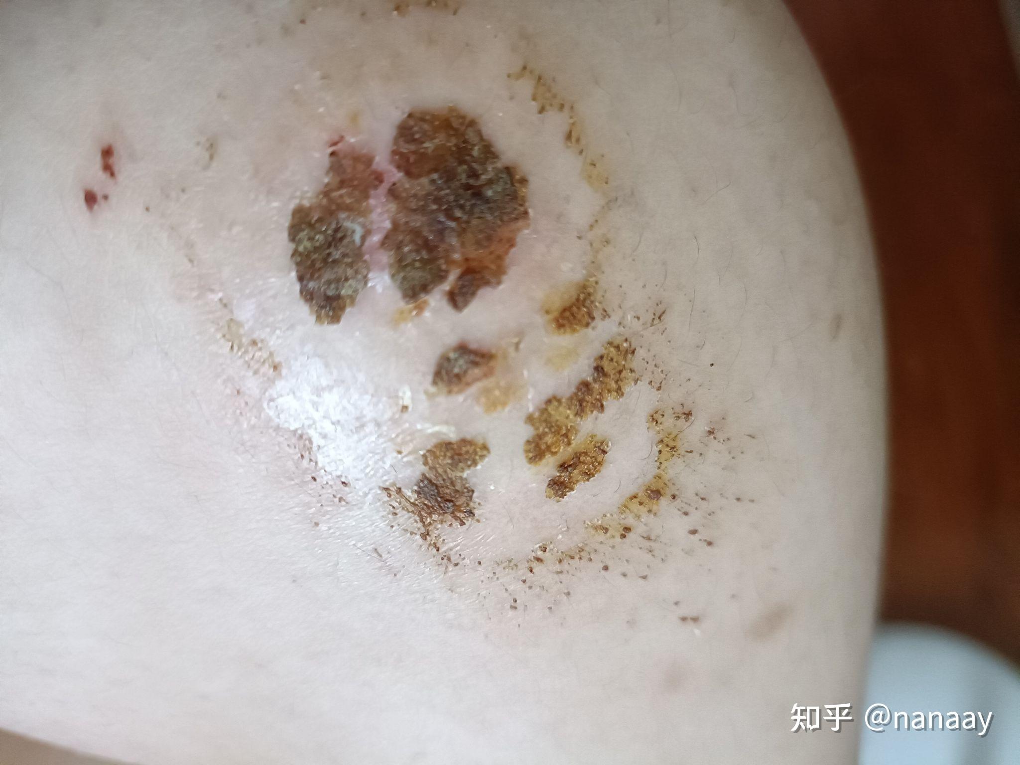 膝盖摔伤,抹了碘伏结痂后如何防止留疤?