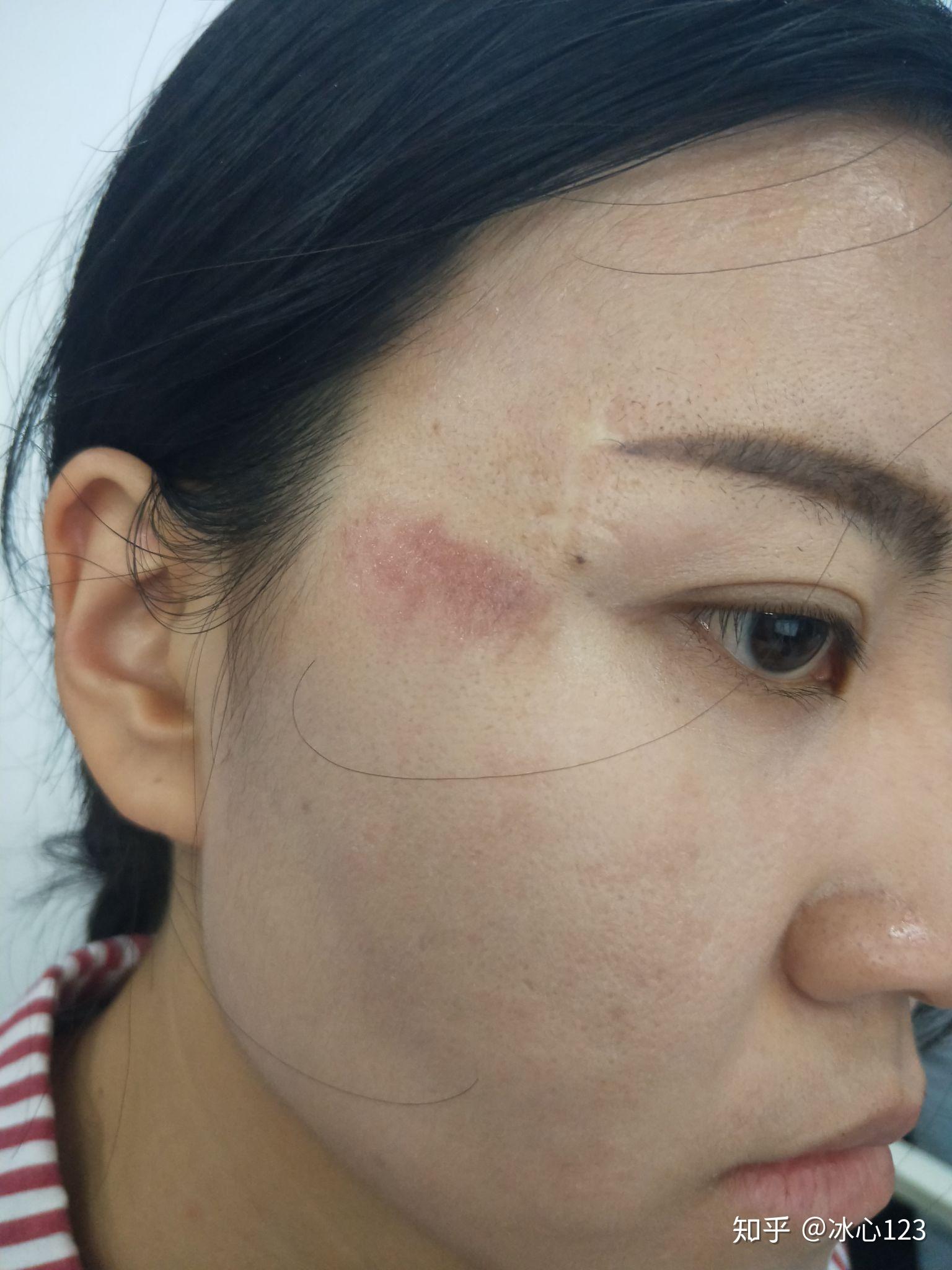 脸部擦伤如图请问如何恢复