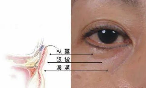 泪沟是什么位置图片图片