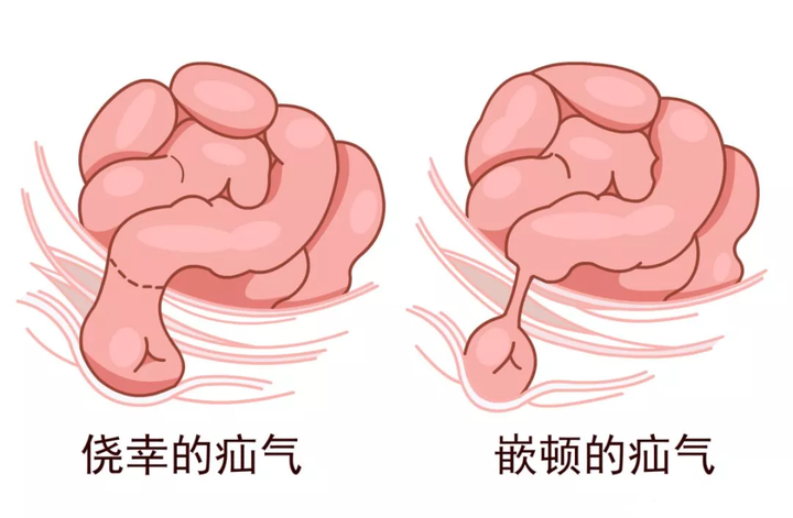 新生儿鞘膜积液图片