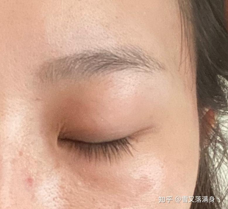 有用过氢醌乳膏祛斑成功的吗说说呗