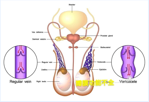 双侧精索静脉曲张是怎么引起的