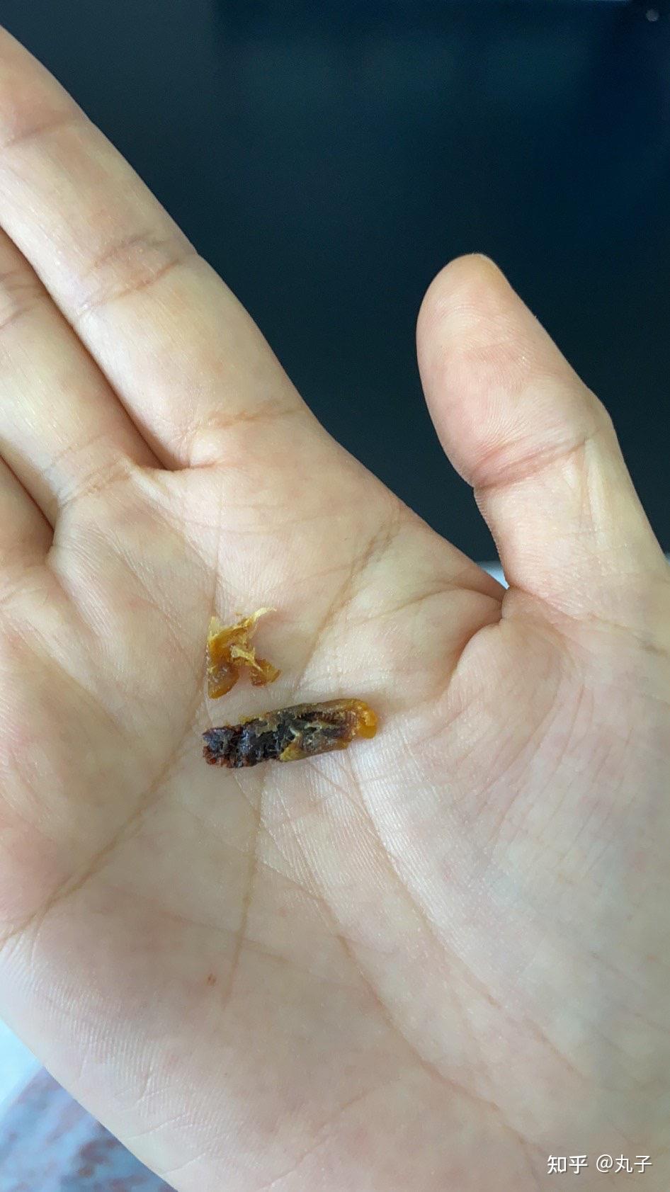 耳屎能大到什么程度