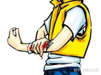 外伤出血不可怕，正确止血是关键 - 知乎