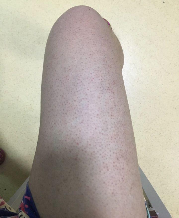 腿上鸡皮疙瘩怎么快速去除教你最快速有效的方法