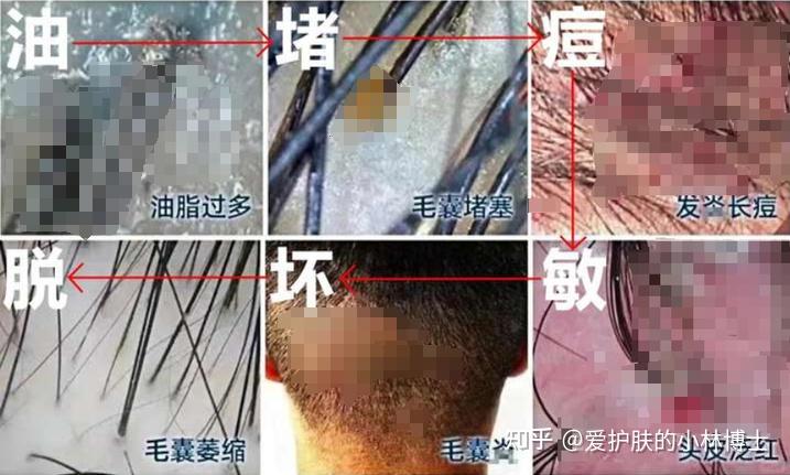 男生头皮不停地长红色小疙瘩,抠了还有血痂,到底怎么彻底解决? - 知乎